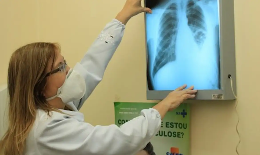 CASOS DE TUBERCULOSE CAEM 35% NO RN; APONTA SESAP