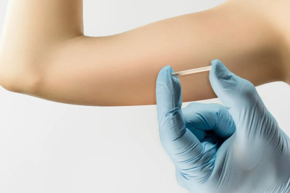 SUS VAI OFERECER IMPLANTE CONTRACEPTIVO DE LONGA DURAÇÃO