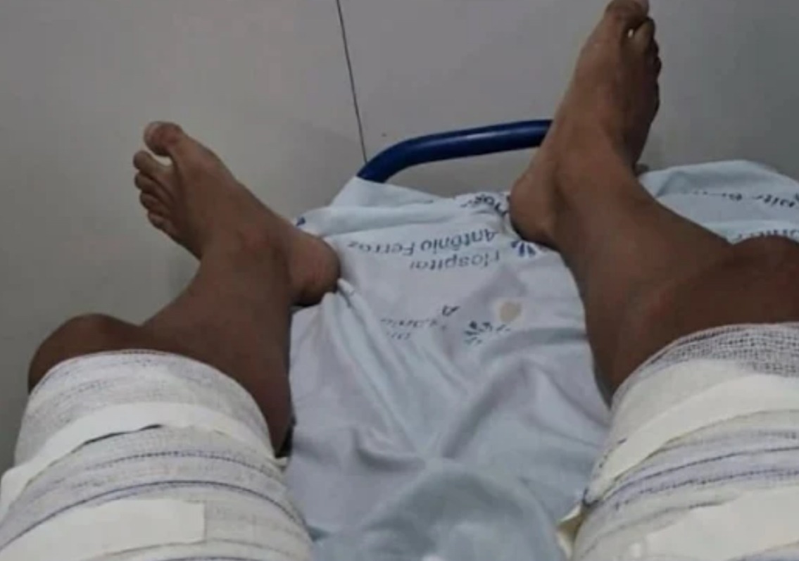MULHER NÃO ACEITA FIM DE RELACIONAMENTO E JOGA ÁGUA FERVENTE NOS ÓRGÃOS GENITAIS DO COMPANHEIRO EM MACAU
