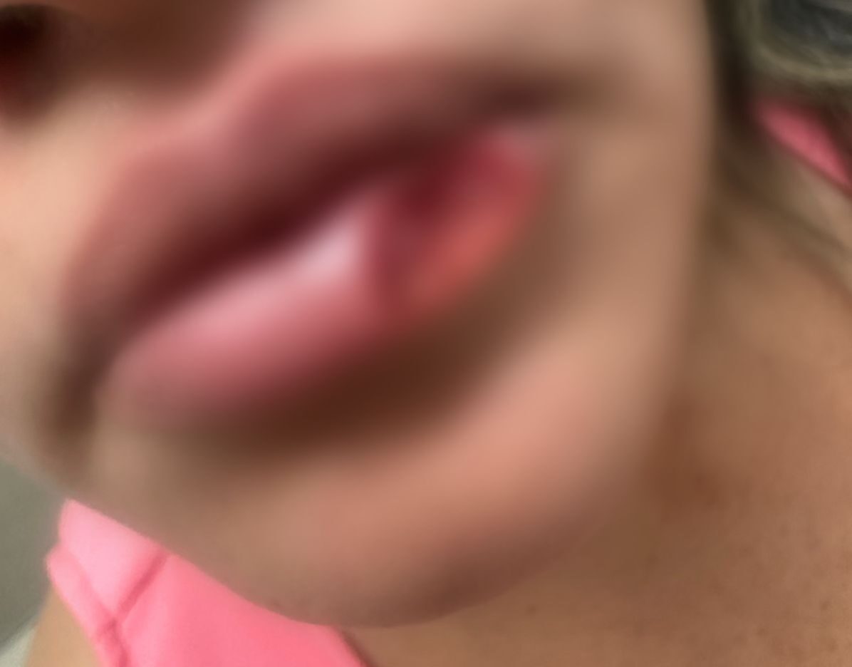 HOMEM ATACA EX-ESPOSA E ARRANCA PARTE DO LÁBIO COM MORDIDA EM NATAL