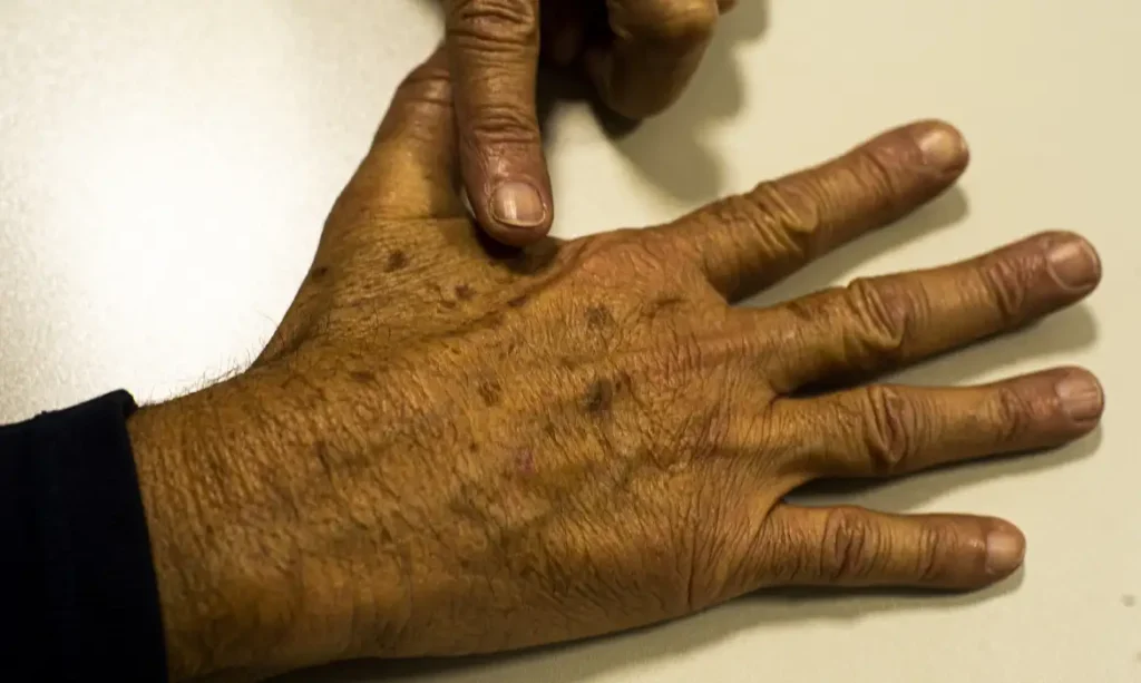 RN REGISTRA MAIS DE 57 MIL CASOS DE CÂNCER EM 5 ANOS; BOLETIM REVELA TENDÊNCIA DE CRESCIMENTO