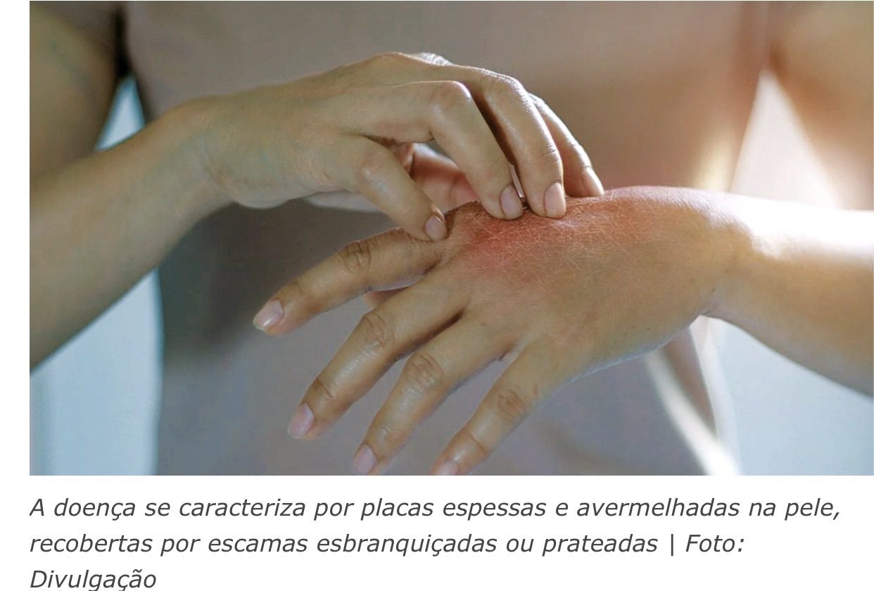 PSORÍASE AFETA CERCA DE 1,5% DOS BRASILEIROS, COMPROMETENDO A PELE E A AUTOESTIMA DOS PACIENTES