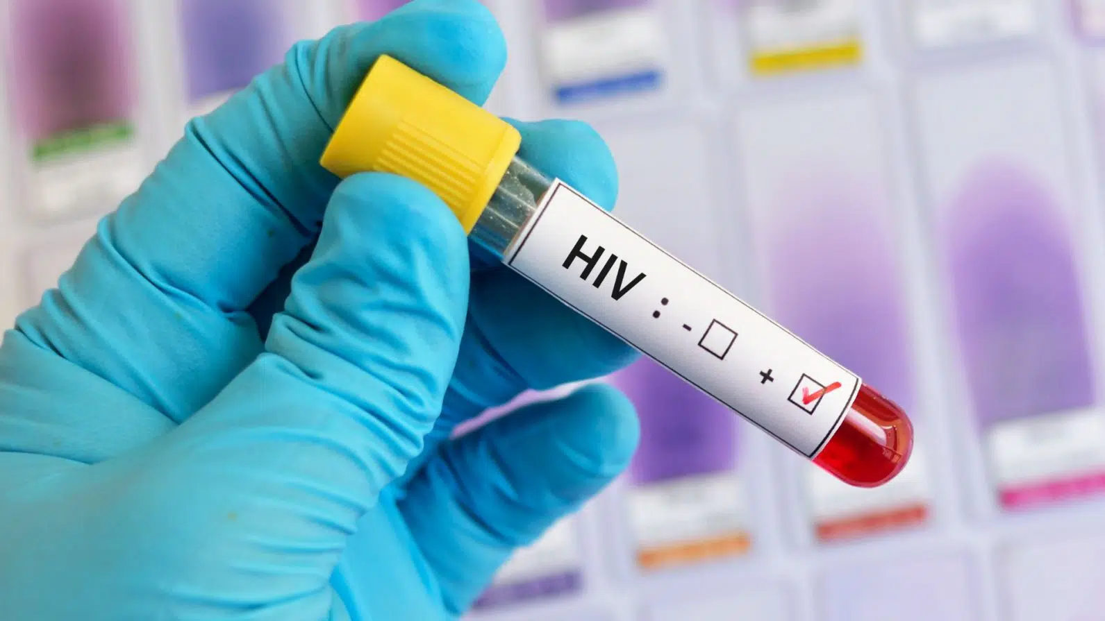 CIENTISTAS DESCOBREM ANTICORPO EFICAZ CONTRA O HIV