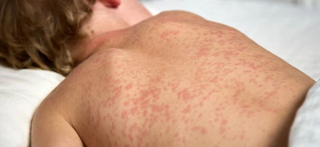 BRASIL SOMA 37 CASOS DE SARAMPO NESTE ANO E REFORÇA VACINAÇÃO EM MEIO À ALTA