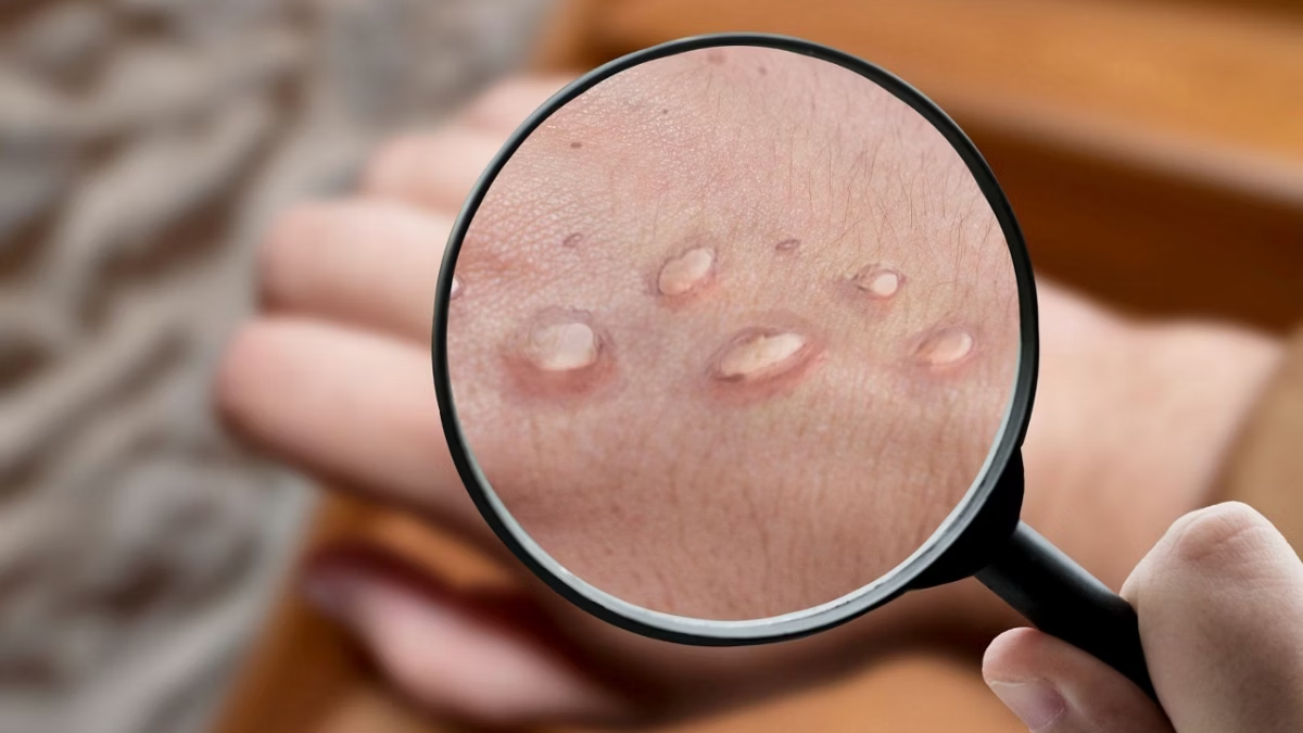 BRASIL CONFIRMA 48 CASOS DE MPOX NOS PRIMEIROS MESES DE 2026